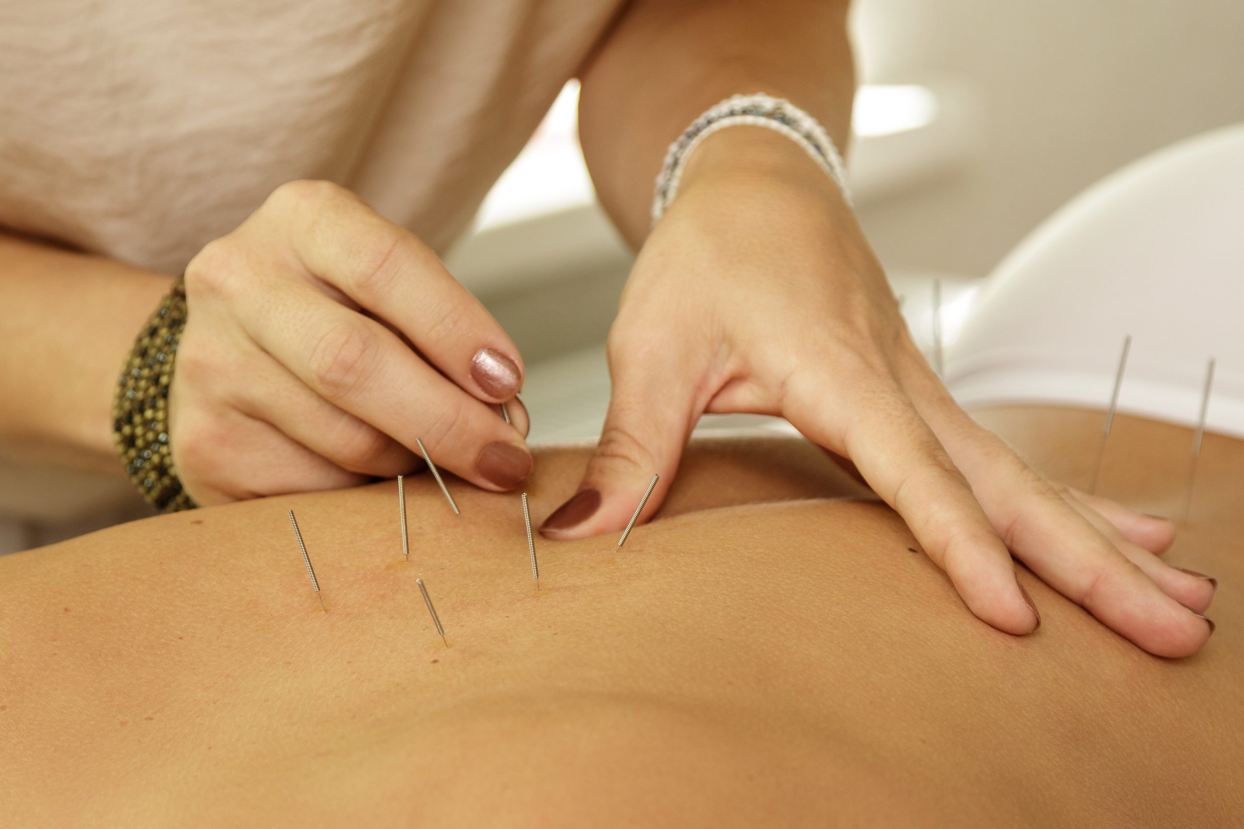 migraña tensional acupuntura