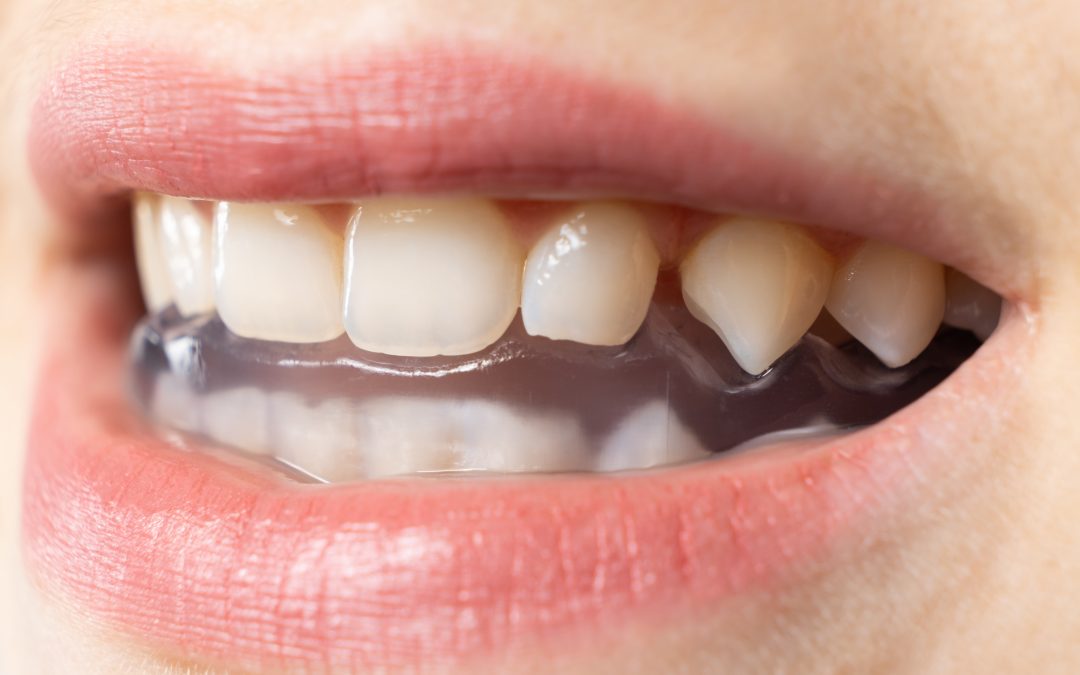 ¿Existe alguna relación entre el bruxismo y las cefaleas primarias?